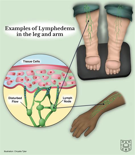 edem massage|Lymphoedema